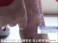 理疗床垫造成“二级烫伤”,厂家称糖尿病导致?